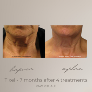 12 Tixel before and after, photo 2 of 18