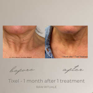 13 Tixel before and after, photo 3 of 18