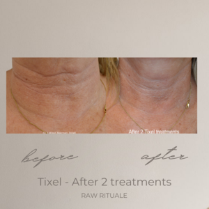 14 Tixel before and after, photo 4 of 18