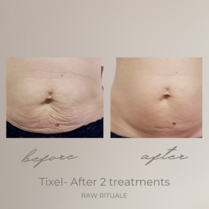 15 Tixel before and after, photo 5 of 18