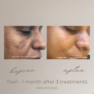 16 Tixel before and after, photo 6 of 18