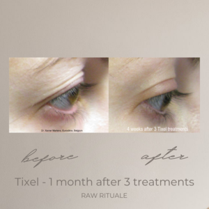 25 Tixel before and after, photo 9 of 18
