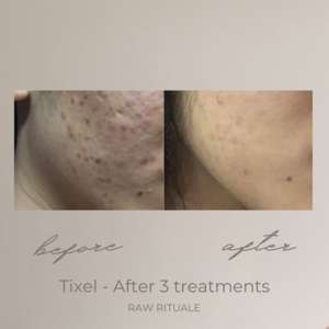 29 Tixel before and after, photo 13 of 18