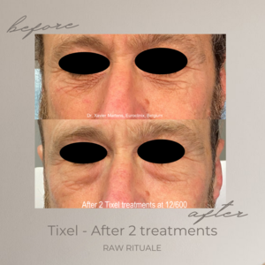 38 Tixel before and after, photo 18 of 18