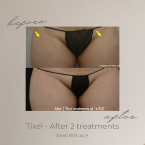 39 Tixel before and after, photo 1 of 18
